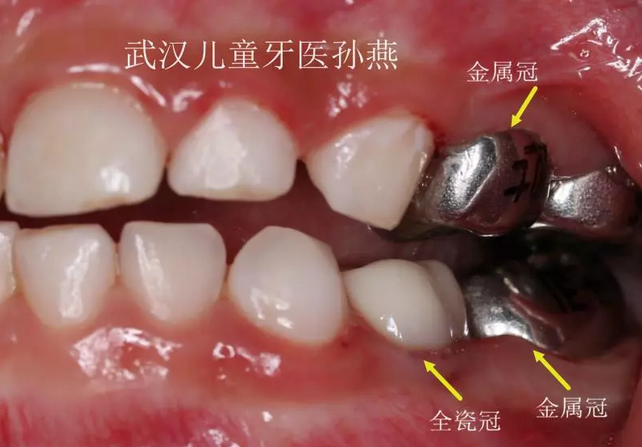 儿童口腔修复新选择:全瓷预成冠,让孩子的笑容